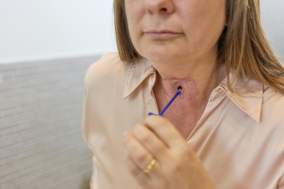 woman cleaning stoma